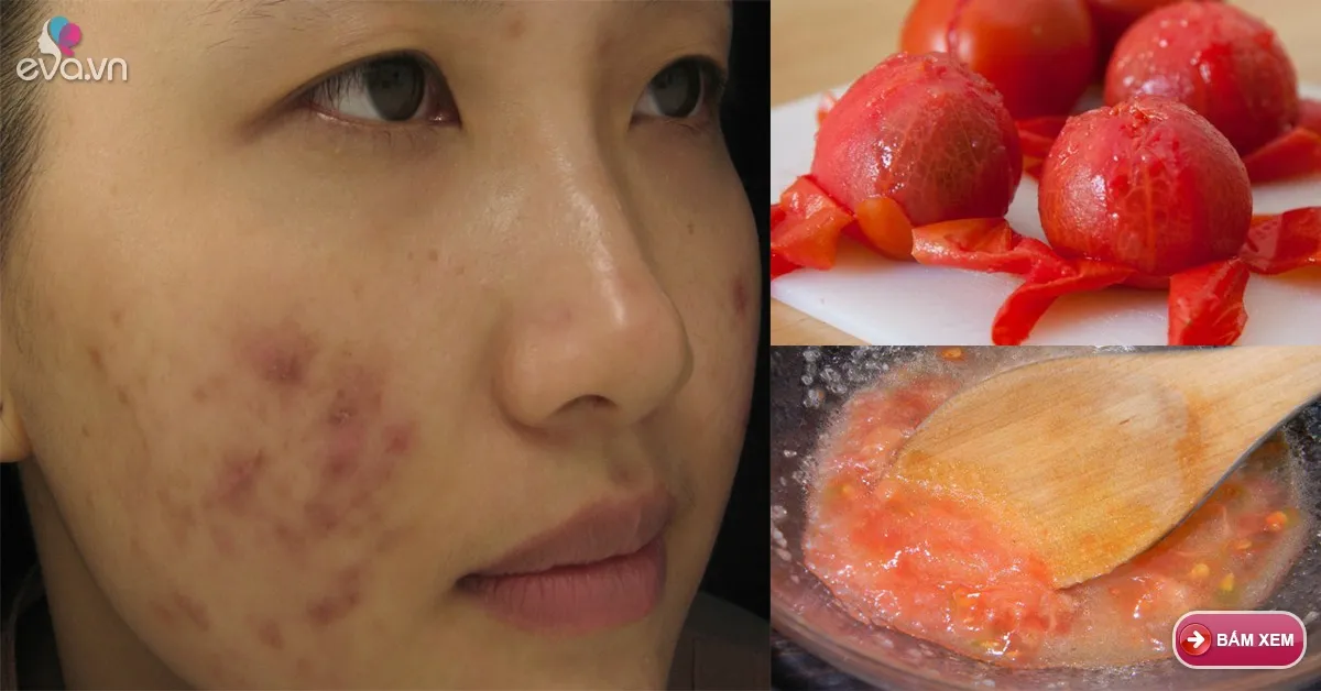 Chế biến cà chua như thế này không ngờ vết thâm sau mụn lại biến mất nhanh chóng