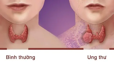 Các phương pháp điều trị ung thư tuyến giáp