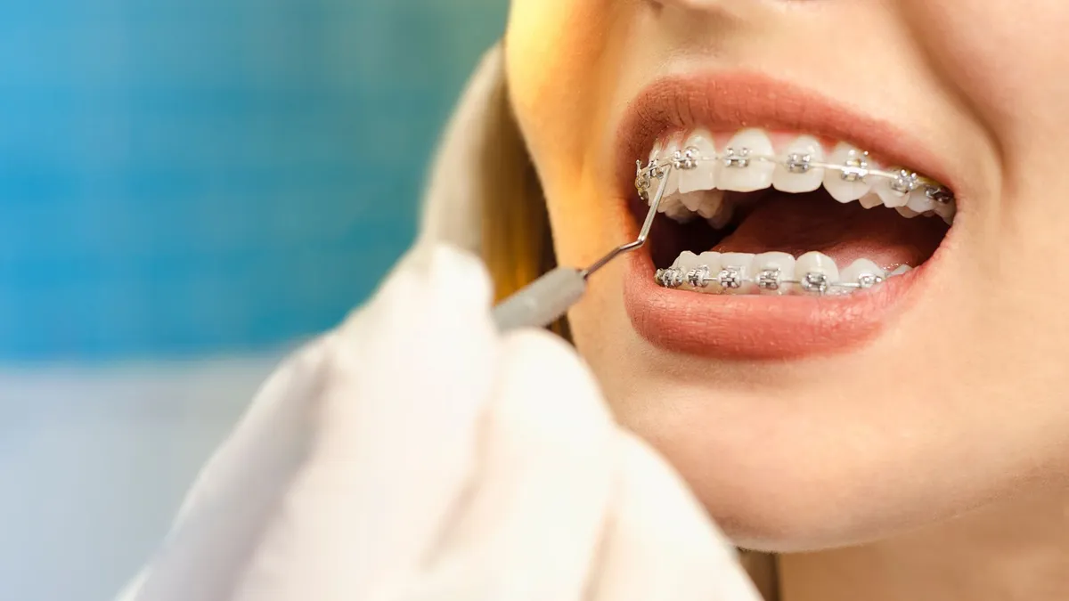 Giá niềng răng cho người lớn là bao nhiêu? Một số loại niềng răng hiện nay