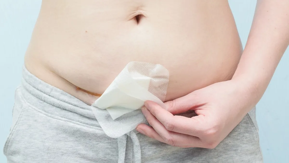 Vết mổ đẻ lần 2 bao lâu thì lành? Cách giúp vết mổ đẻ nhanh lành