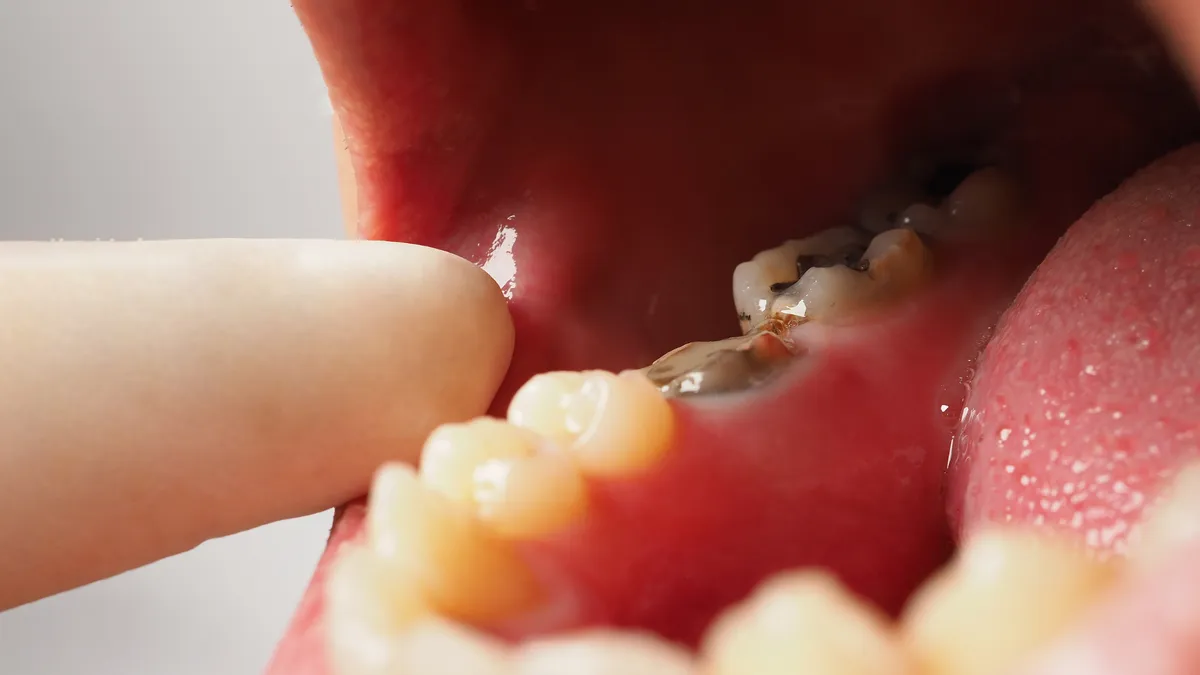 Răng sâu bị vỡ chỉ còn chân răng phải làm sao? Cách xử lý và phòng ngừa hiệu quả