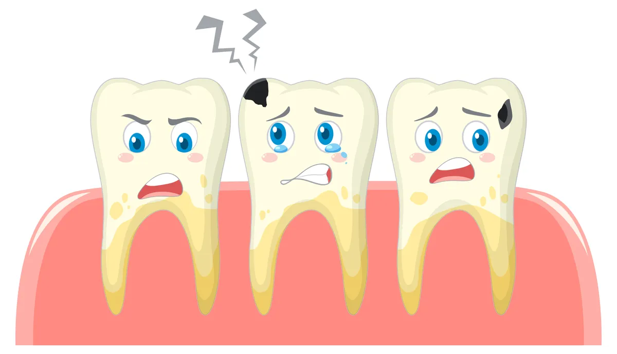 Răng sâu bị thối là gì? Dấu hiệu nhận biết và cách điều trị đúng