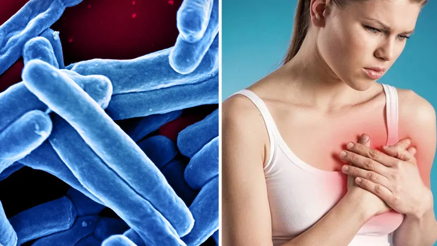 Lao vú có lây không? Cách phòng ngừa bệnh lao vú hiệu quả