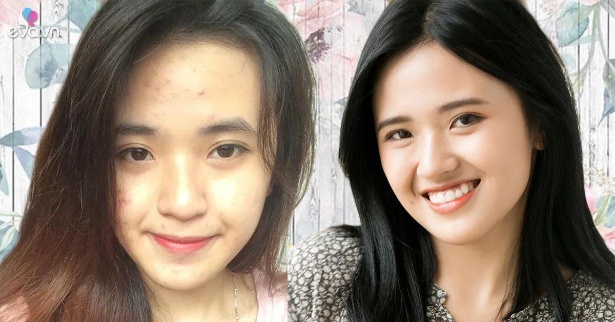 Bỏ túi 2 cách này mụn ẩn cứng đầu đến đâu cũng sạch bách đến đấy