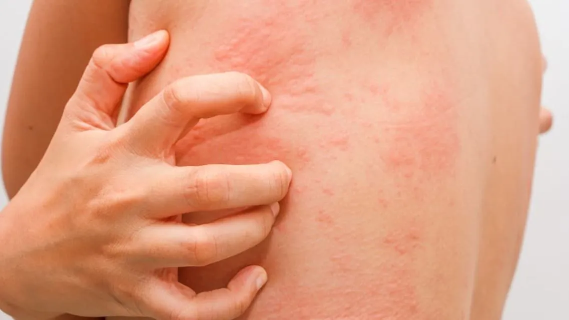 Nổi mề đay có tự hết không? Khi nào cần đi khám?