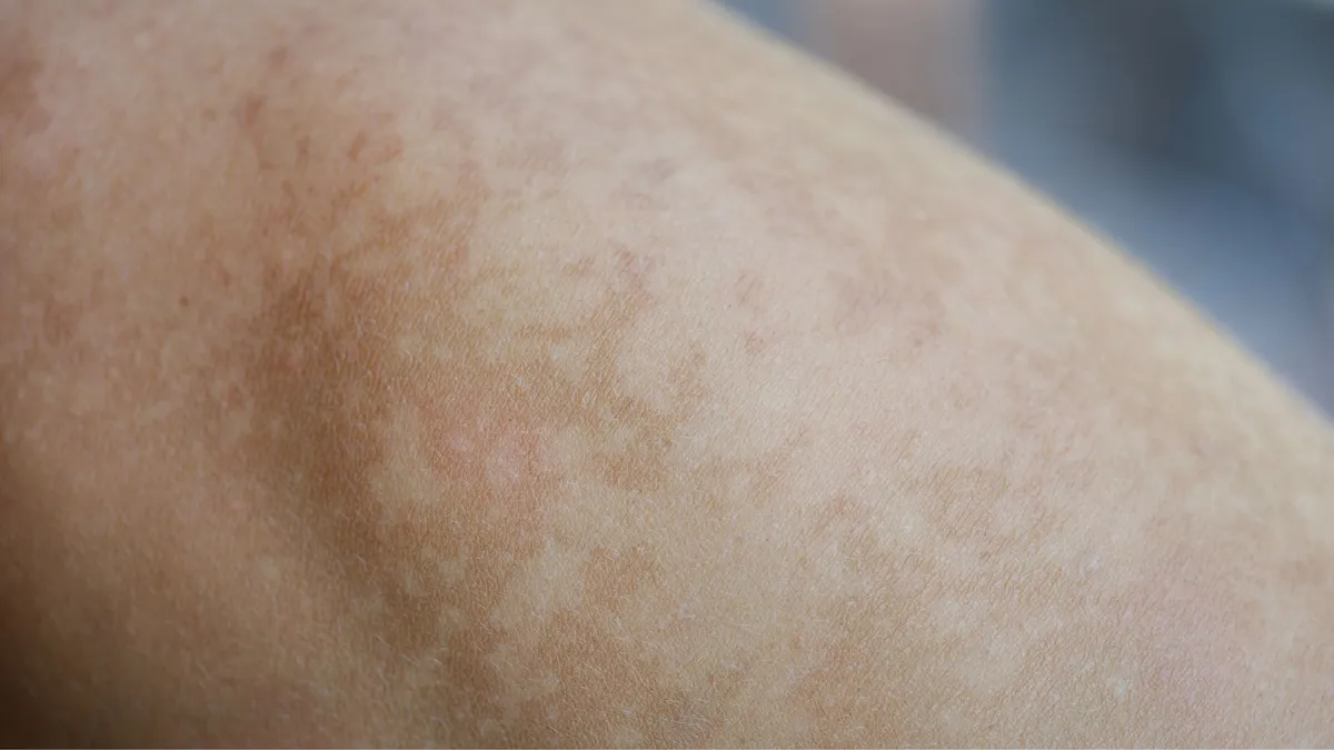 Cách trị nám ở chân hiệu quả tại nhà