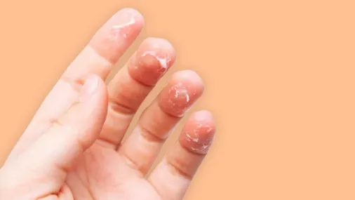 Trẻ bị tróc da đầu ngón tay thiếu chất gì? Xử lý như thế nào?