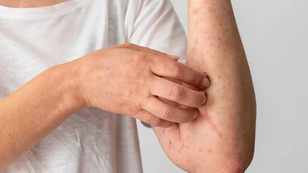 Nổi mề đay uống Bổ gan Tâm Bình được không? Những điều cần biết