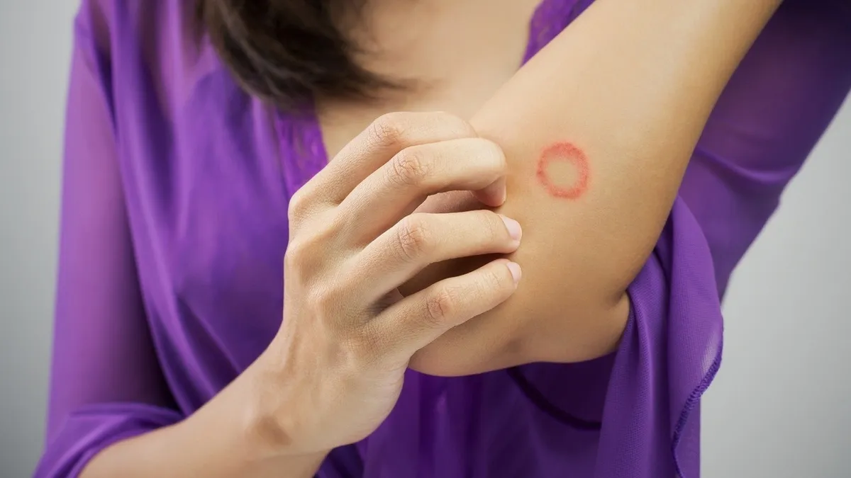 Bệnh lác đồng tiền có tự khỏi không? 3 sai lầm khiến bệnh nặng hơn