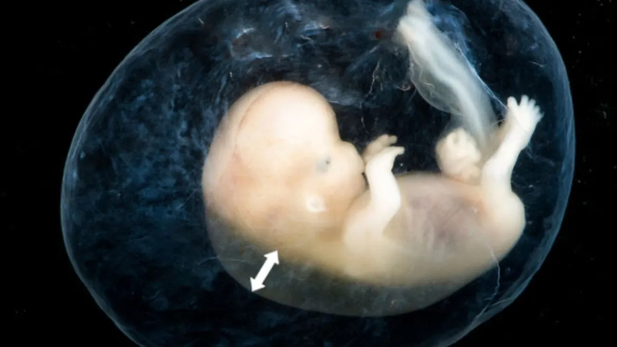 Độ mờ da gáy bất thường phải làm sao? Nguyên nhân và cách xử trí đúng