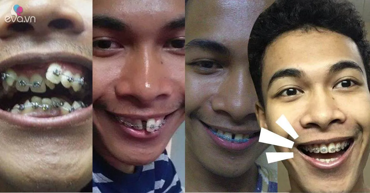 Ngỡ ngàng trước sự lột xác vi diệu nhờ niềng răng, dung mạo thay đổi 180 độ