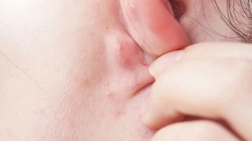 Nổi hạch sau tai không đau: Cảnh báo bệnh lý và khi nào cần khám?