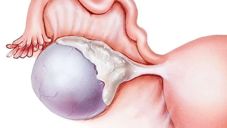 Khi nào nên đốt nang naboth cổ tử cung? Đốt nang naboth cổ tử cung giá bao nhiêu?