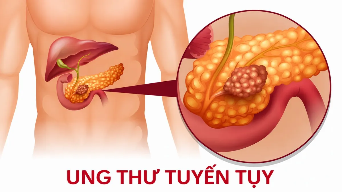 3 dấu hiệu ung thư tuyến tụy nhiều người Việt chỉ nghĩ là rối loạn tiêu hóa bình thường