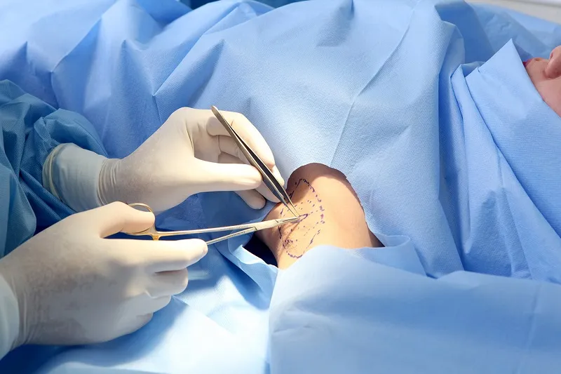 Mọi điều cần biết về cắt tuyến mồ hôi nách