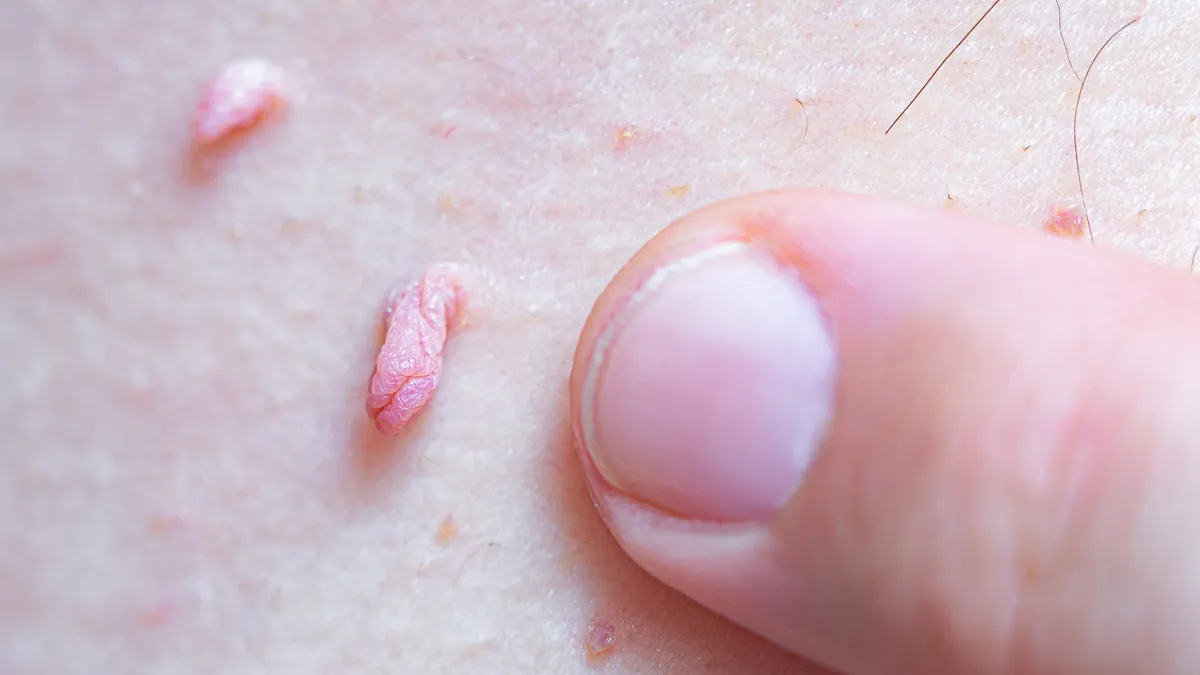 Dấu hiệu nhận biết sùi mào gà giai đoạn đầu và cách xử lý sớm