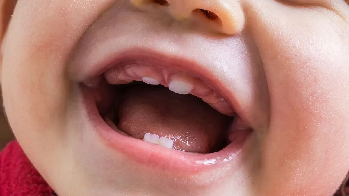 Thứ tự mọc răng sữa ở trẻ và những lưu ý khi trẻ mọc răng sữa