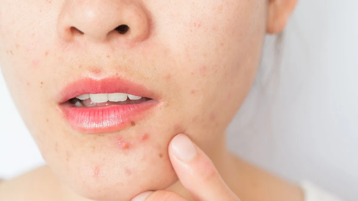 Tìm hiểu phác đồ điều trị mụn trứng cá Bộ Y tế