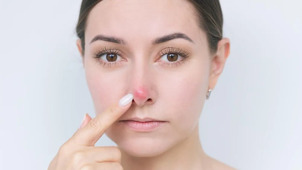 Nguyên nhân mọc mụn ở mũi và cách khắc phục tại nhà