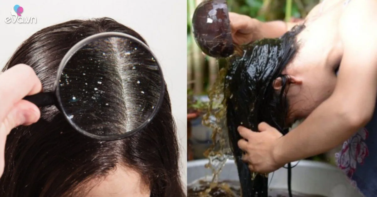 Gội đầu liên tục mà gàu vẫn tróc từng mảng, thử áp dụng những công thức tự nhiên này