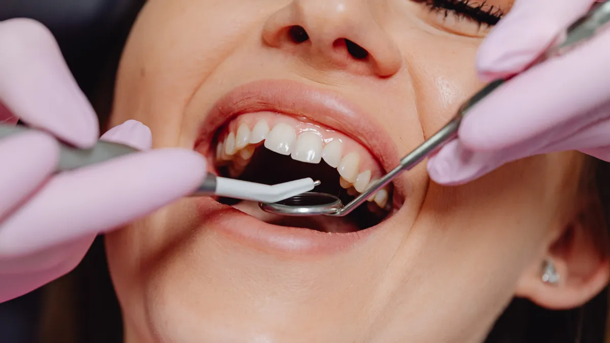 Răng bị vôi hóa là gì và cách chăm sóc giúp bảo vệ men răng