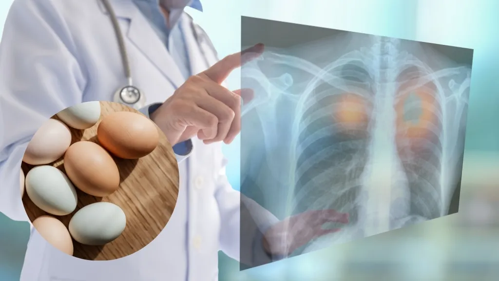 Ung thư phổi có ăn trứng gà được không? Hướng dẫn ăn đúng cách