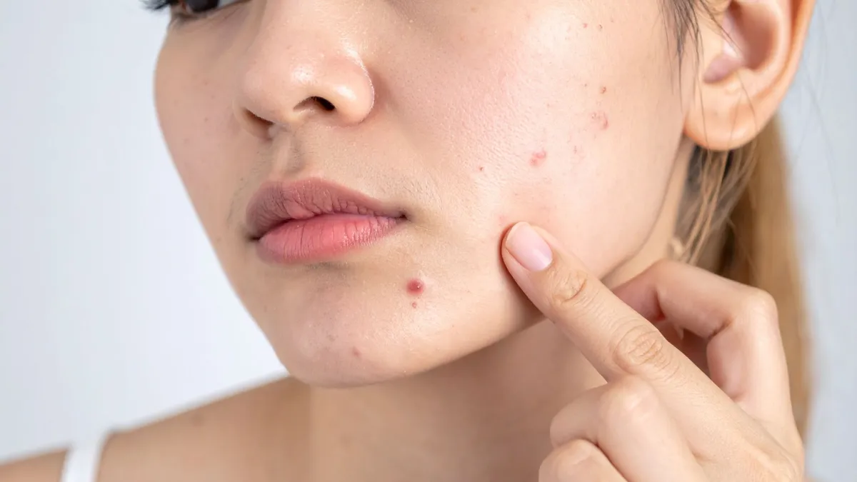 Vị trí nổi mụn nói lên điều gì? Cảnh báo vấn đề sức khỏe bạn nên biết