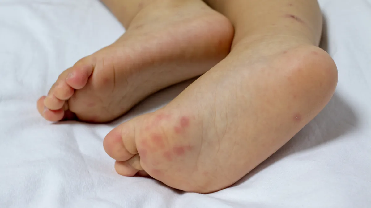 Cảnh báo những sai lầm khi chăm sóc trẻ mắc tay chân miệng tại nhà