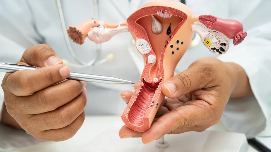 Cách chữa buồng trứng có nhiều nang nhỏ an toàn, hiệu quả