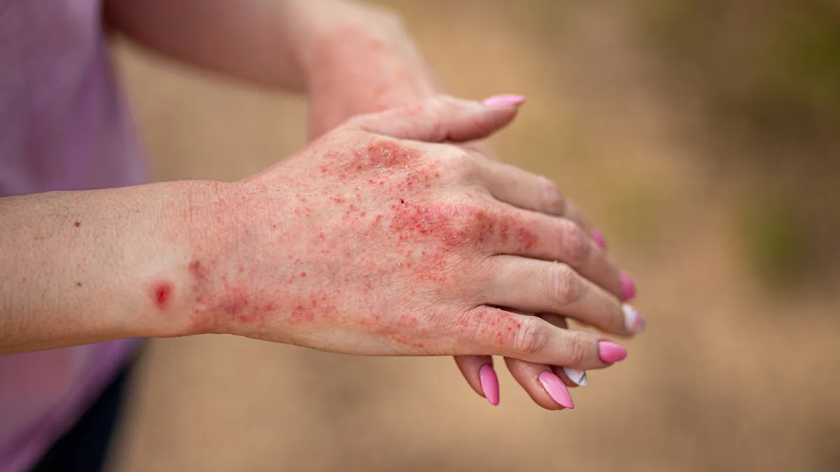 Phác đồ điều trị lupus ban đỏ hệ thống theo từng mức độ