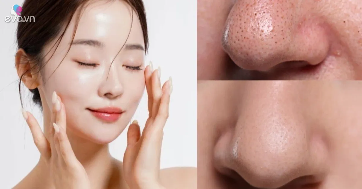 Tại sao nói mụn đầu đen là "khắc tinh" của tài lộc? Bác sĩ da liễu chỉ cách dọn sạch bong từng lỗ chân lông