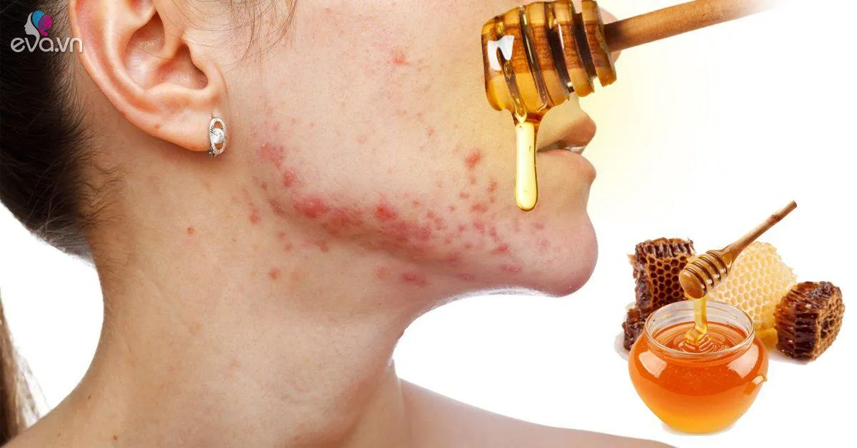 Dù kết hợp nguyên liệu gì với mật ong cũng có thể chế ra "thần dược" trị mụn