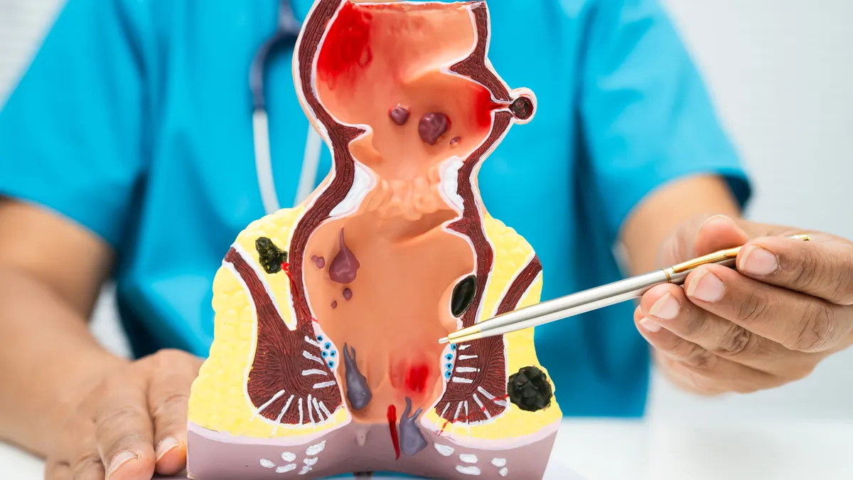 Những dấu hiệu trĩ nội và cách phòng ngừa chúng