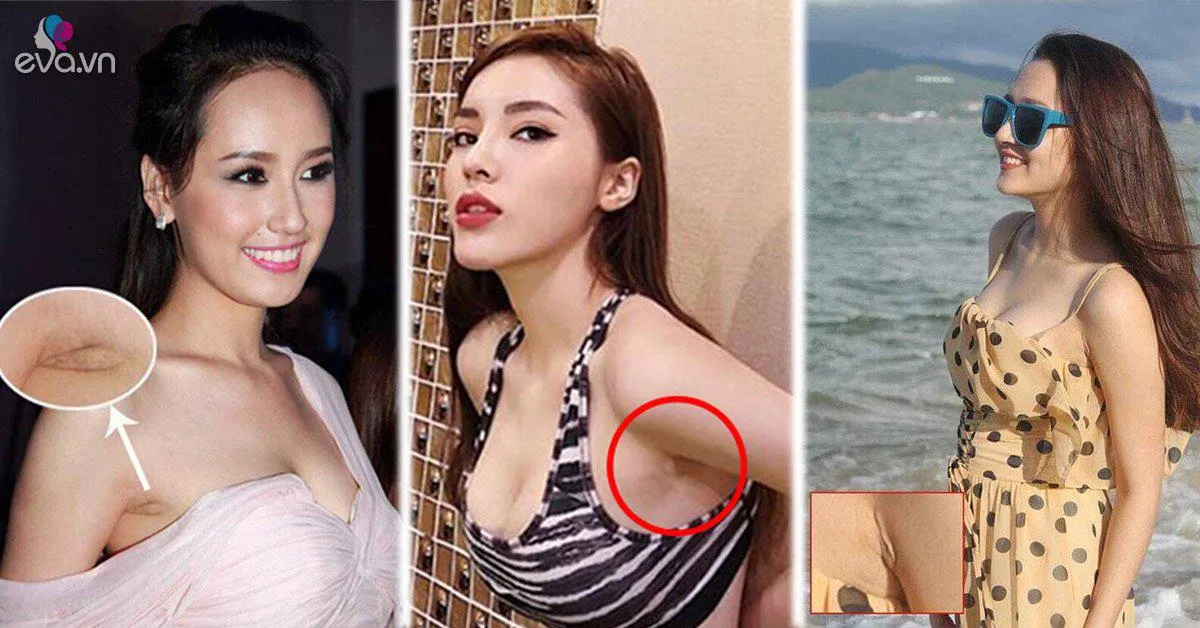 Im lặng hay phủ nhận "dao kéo", thì vết sẹo kì lạ này cũng đã lên tiếng thay chủ nhân!