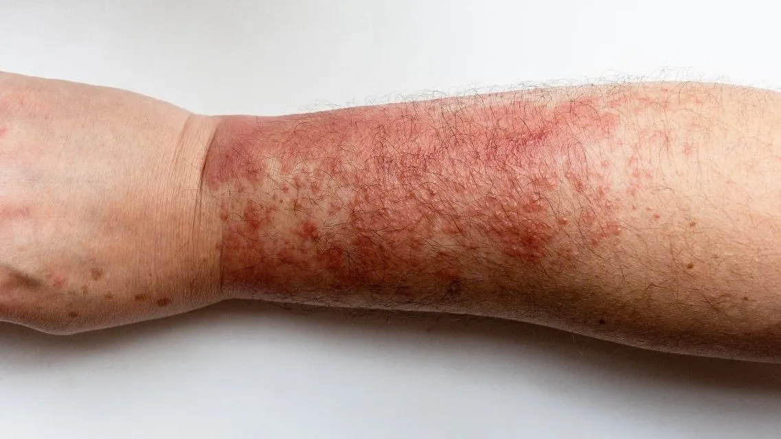 Viêm da tiếp xúc ánh sáng là gì? Nguyên nhân, triệu chứng, cách điều trị