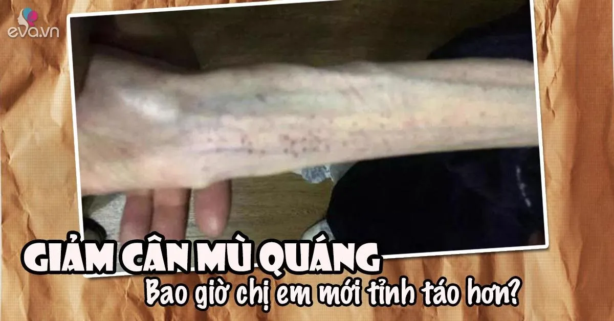 Phát hoảng với cánh tay tong teo sau giảm cân, sao chị em cứ không màng hậu quả vậy nhỉ?