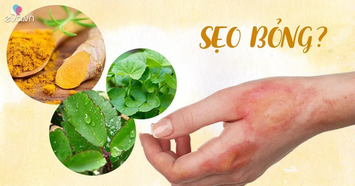 Sẹo bỏng có nặng đến mấy cũng hết nếu áp dụng mẹo sau!