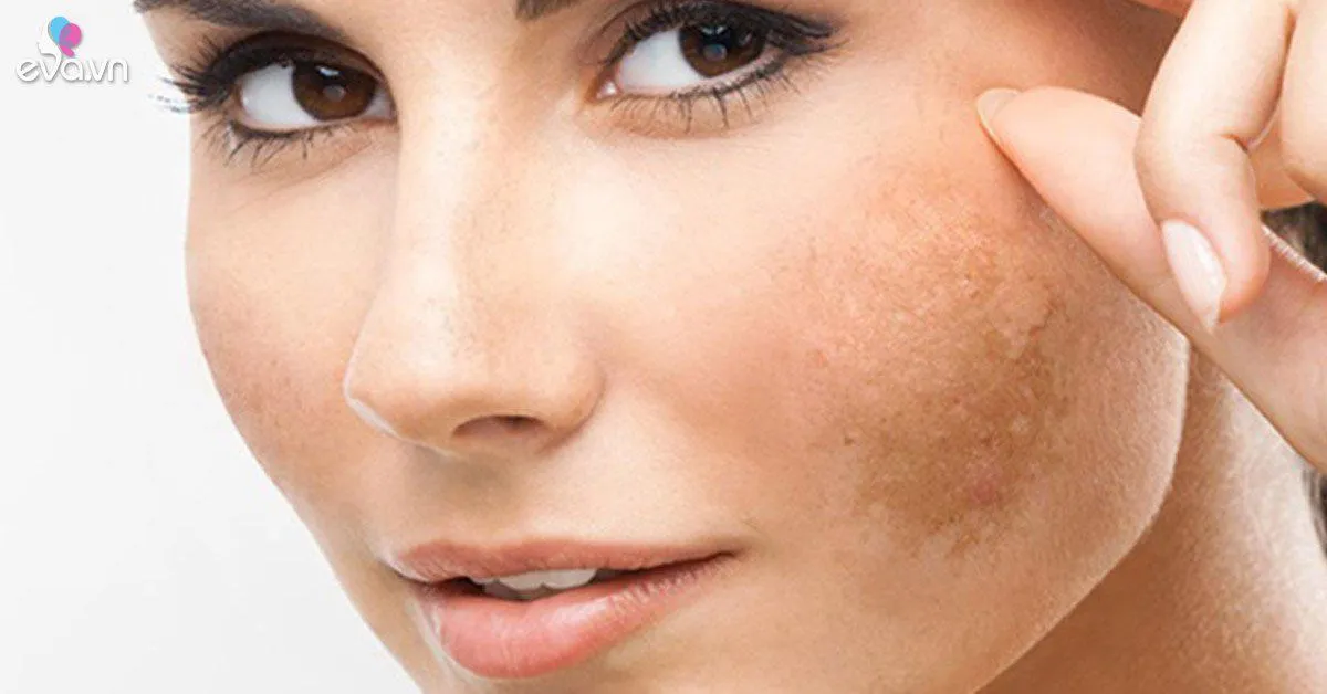 Da đẹp lên trông thấy nhờ cách trị nám mặt bằng mật ong chỉ trong 2 tuần!