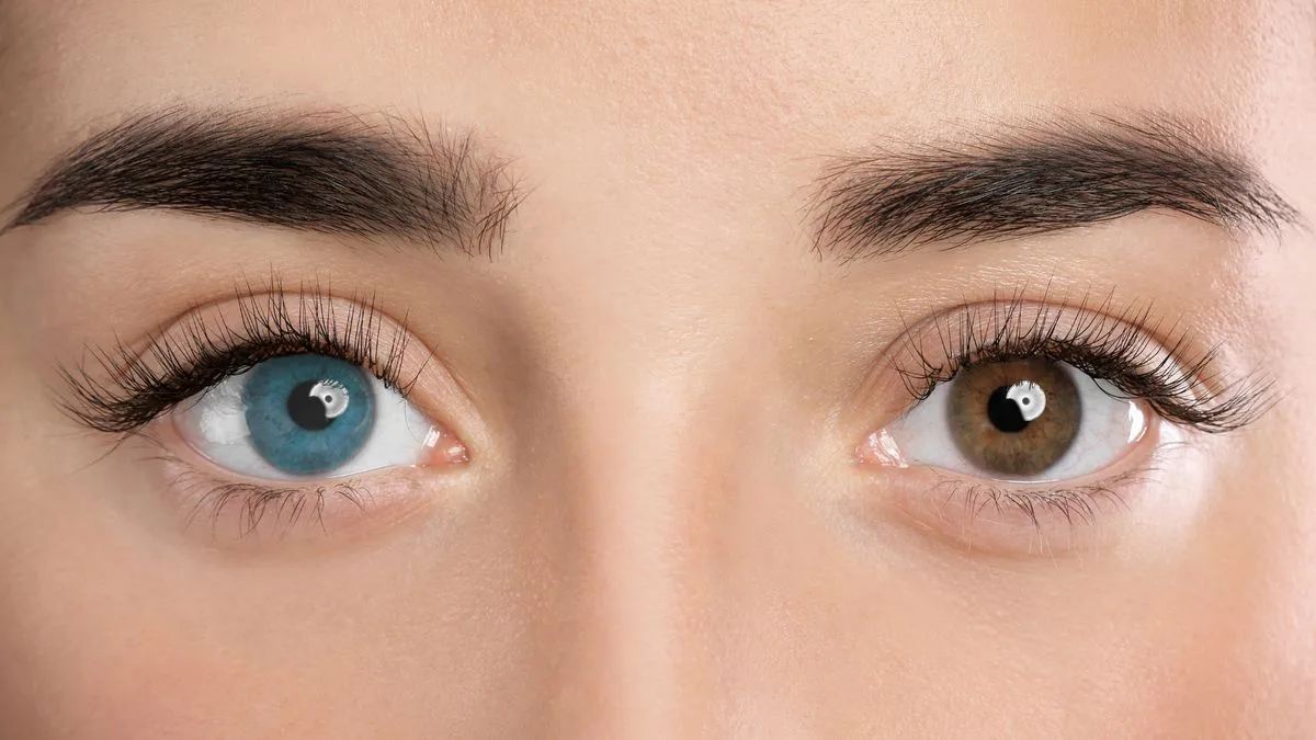 Heterochromia là gì? Nguyên nhân và các dạng Heterochromia phổ biến