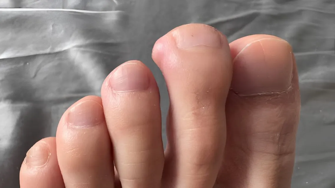 U bướu ở ngón chân là bệnh gì? Có nguy hiểm không?