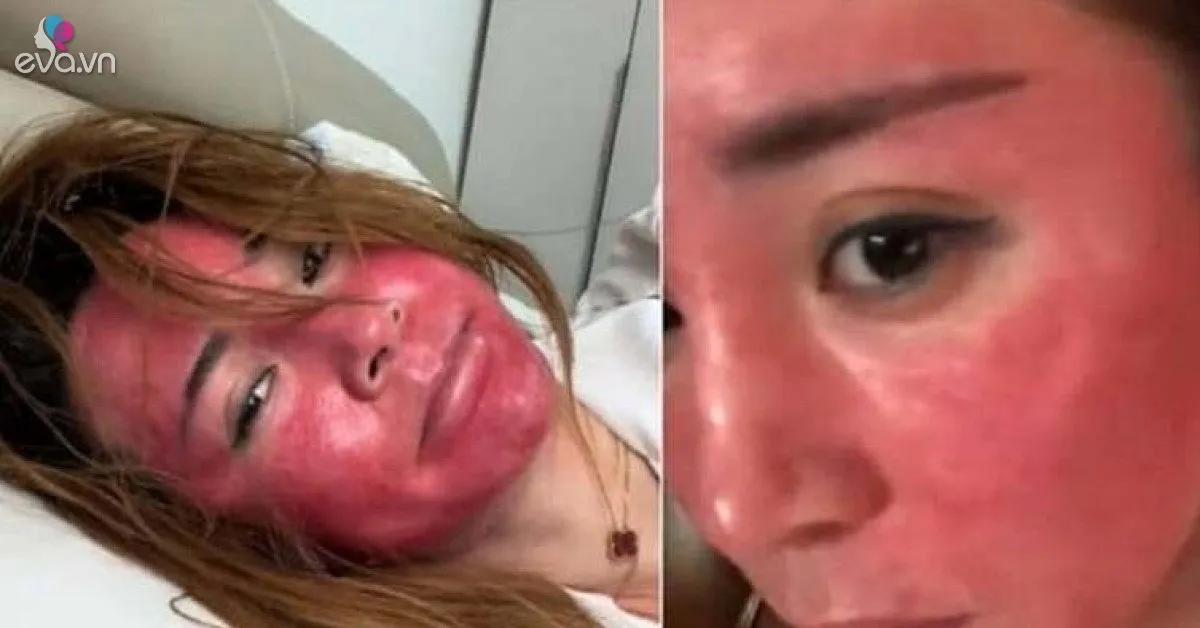 Mặt sưng đỏ, biến dạng sau 22 năm không tẩy trang