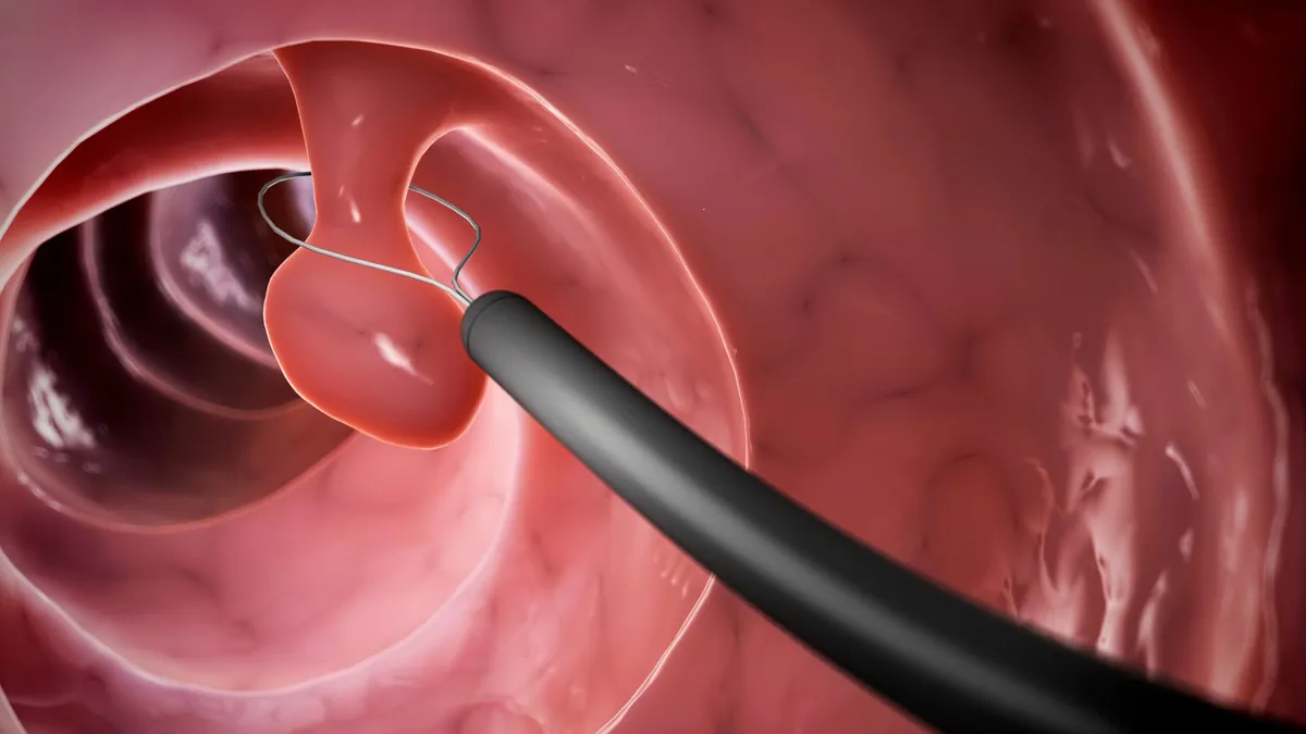 Khi nào cần cắt polyp dạ dày qua nội soi? Cần lưu ý gì khi cắt polyp dạ dày?