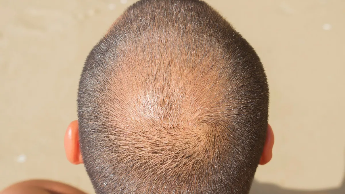 Các loại khối u trên đầu thường gặp là gì? Dấu hiệu nhận biết khối u nguy hiểm