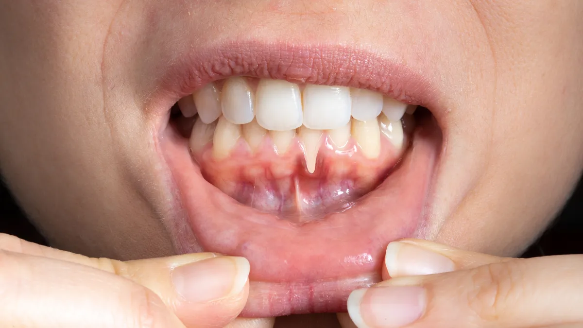 Tụt lợi chân răng có chữa được không và phương pháp cải thiện hiện nay
