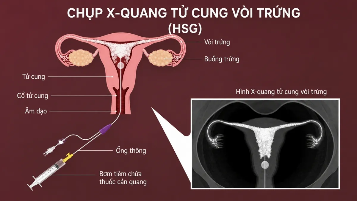 Trước khi chụp tử cung vòi trứng cần làm gì? Hướng dẫn chi tiết
