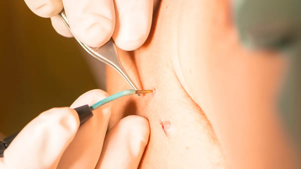 U nhú hậu môn: Nguyên nhân, triệu chứng và phương pháp điều trị hiệu quả
