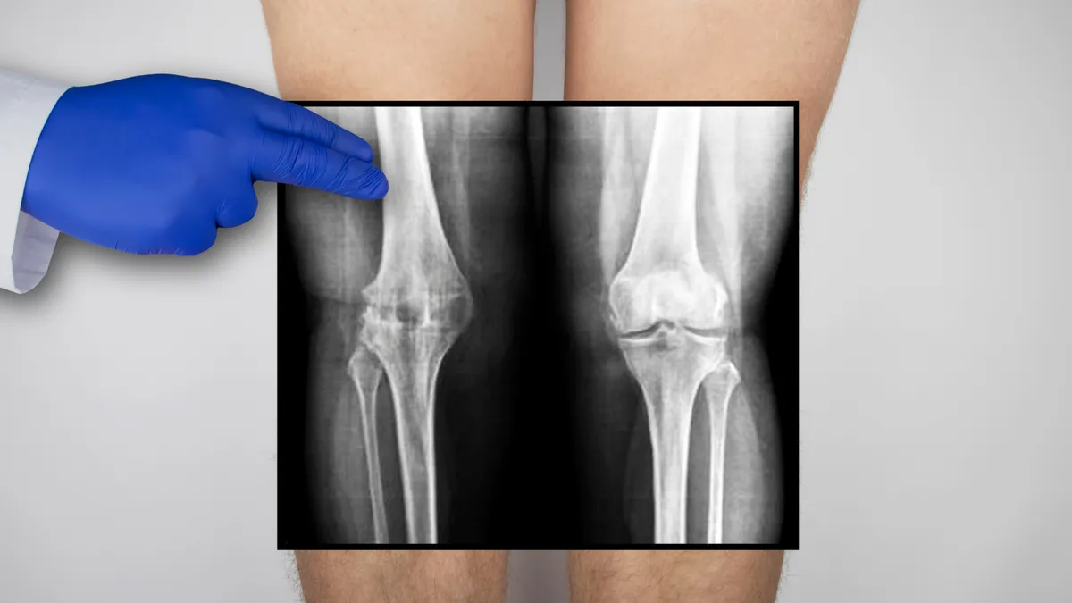 MRI đứt dây chằng chéo trước là gì? Phương pháp cải thiện tình trạng đứt dây chằng chéo trước