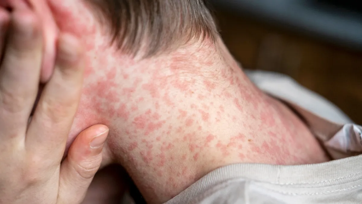 Rối loạn dây thần kinh sọ ở bệnh nhân lupus: Những nguy cơ tiềm ẩn