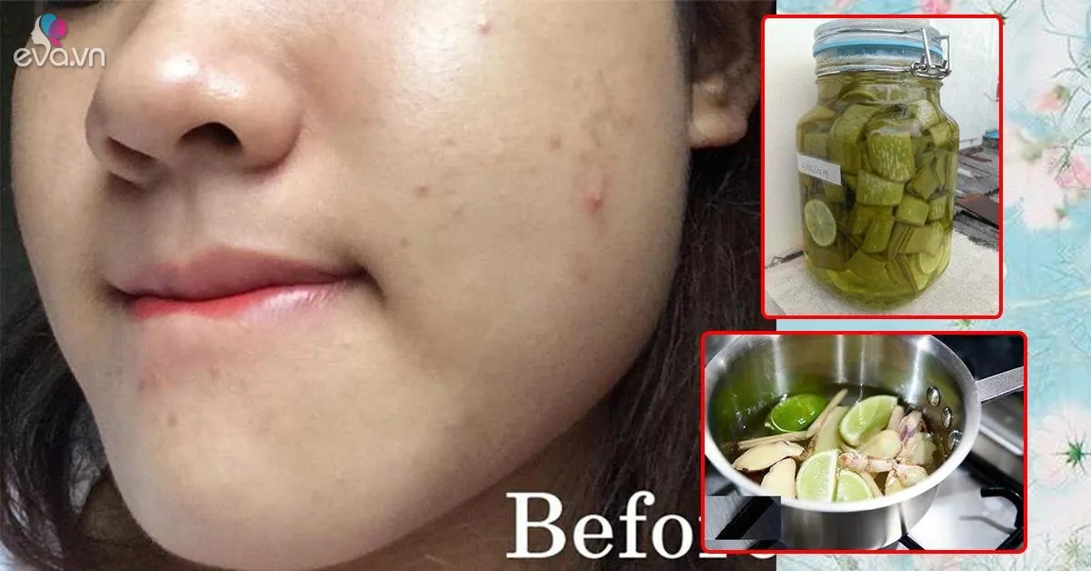 2 cách trị mụn ẩn hiệu quả nhất, da đẹp đón Tết hơn cả đống mỹ phẩm đắt tiền