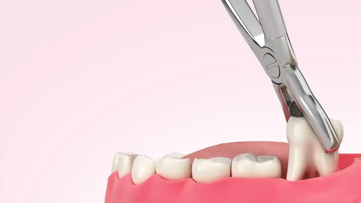 Nhổ răng khôn có cần phải nghỉ làm không? Khi nào đi làm lại?